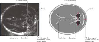 Nuchal Fold 1.75 Mm (20 Weeks Of Gestation, Ultrasound Examination). |  Download Scientific Diagram