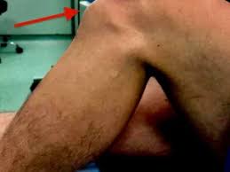 Tibial Tuberosity